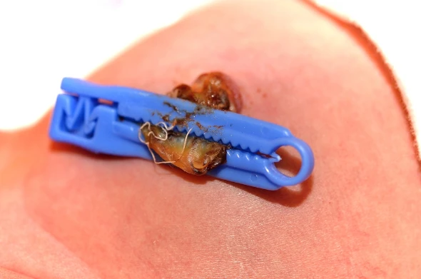 Κολόβωμα με τσιμπιδάκι