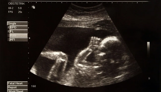 Ultrasound-baby-sucking-thumb-small